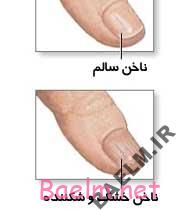 علت خشکی و شکنندگی ناخن ها چيست؟