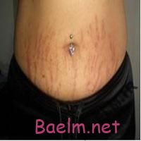 ترک پوستی یا استریا (Striae) و راههاي درمان