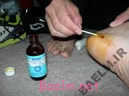 دارونامه | موارد مصرف و عوارض داروي تنتور بنزوئین