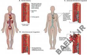 بيماري شناسي | انعقاد داخل عروق منتشر 14