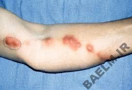 بيماري شناسي | اسپوروتریكوز 2224242