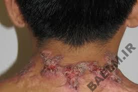 بيماري شناسي | اسپوروتریكوز 343434