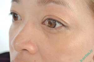  لنز, لنز رنگی, لنز طبی