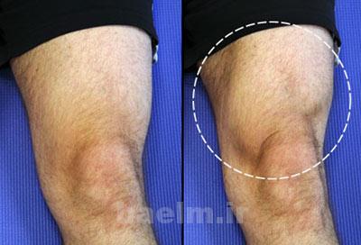 آرتروز زانو,درمان آرتروز زانو,درمان آرتروز زانو با ورزش