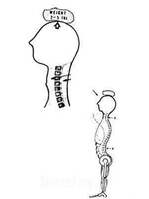 ورزش درمانی,حرکات اصلاحی برای ناهنجاری سر به جلو,تمرینات ورزشی
