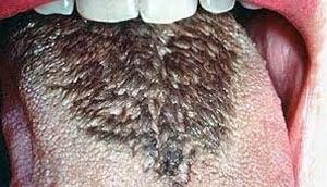 بیماریهای زبان, سندرم داون بیماریهای زبان, سندرم داون