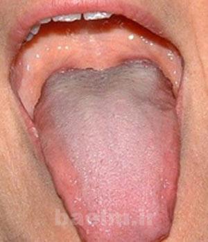 بیماریهای زبان, سندرم داون بیماریهای زبان, سندرم داون