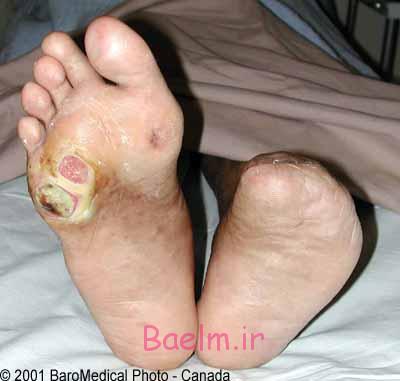 محققان آمریکایی برای درمان زخم پای بیماران دیابتی، چسب جدیدی تولید کرده‌اند