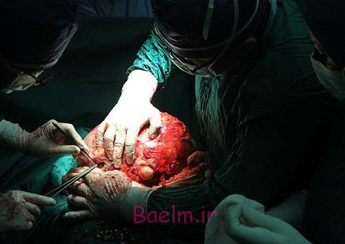 (تصاویر) درآوردن تومور 10کیلویی از شکم (تصاویر) درآوردن تومور 10کیلویی از شکم
