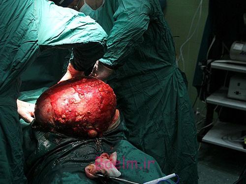 (تصاویر) درآوردن تومور 10کیلویی از شکم (تصاویر) درآوردن تومور 10کیلویی از شکم