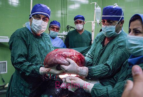 (تصاویر) درآوردن تومور 10کیلویی از شکم (تصاویر) درآوردن تومور 10کیلویی از شکم