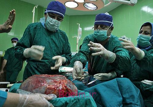 (تصاویر) درآوردن تومور 10کیلویی از شکم (تصاویر) درآوردن تومور 10کیلویی از شکم