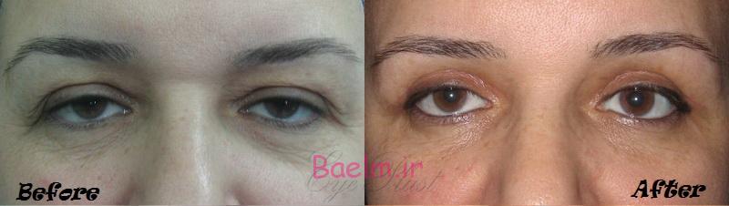 زيبايي | حركات تمريني چشم براي كمتر كردن و جلوگيري از افتادگي پلك