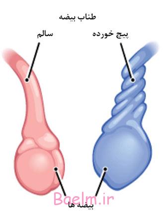 پزشكي | پیچش بیضه ؛ دلايل ، علائم و راههاي درمان پيچش بيضه