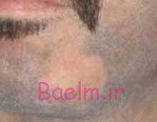 کم مویی پسران ,مشکل کم مویی مردان کم مویی پسران ,مشکل کم مویی مردان