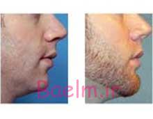 کم مویی پسران ,مشکل کم مویی مردان کم مویی پسران ,مشکل کم مویی مردان