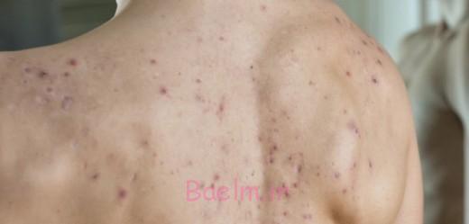 روش های از بین بردن جوش های پشت بدن روش های از بین بردن جوش های پشت بدن