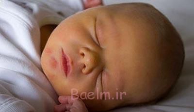 زردی،زردی در نوزادان،زردی در کودکان داروی زردی نوزاد,علت زردی نوزاد