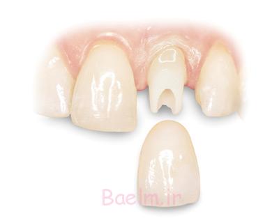 پروتز دندان,پروتز دندان متحرک,پروتز ثابت دندان