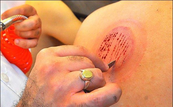 برای چه بیماری هایی میتوان از حجامت استفاده کرد ؟ حجامت 32