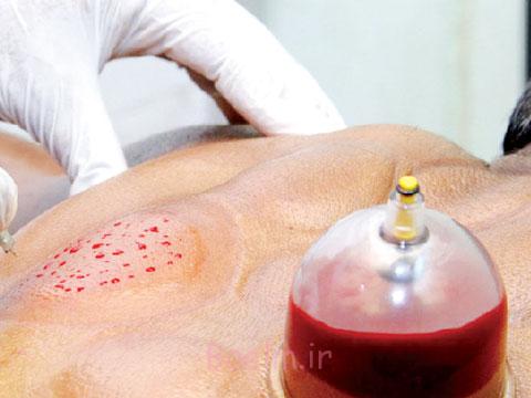برای چه بیماری هایی میتوان از حجامت استفاده کرد ؟ حجامت