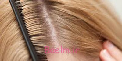 علت جوش کف سر،ماست برای جوش سر علت جوش کف سر