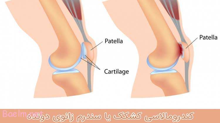 کندرومالاسی کشکک یا سندرم زانوی دونده