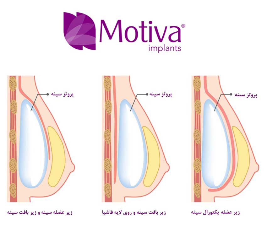 پروتز سینه - مهم ترین نکات در مورد آن بطور کلی سه تکنیک و روش برای برش و قرار دادن پروتز داخل بدن داریم: