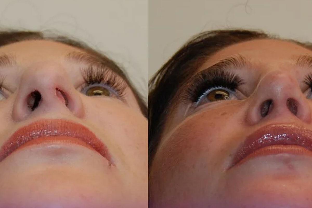 عمل جراحی بینی برای چه کسانی مناسب نیست؟