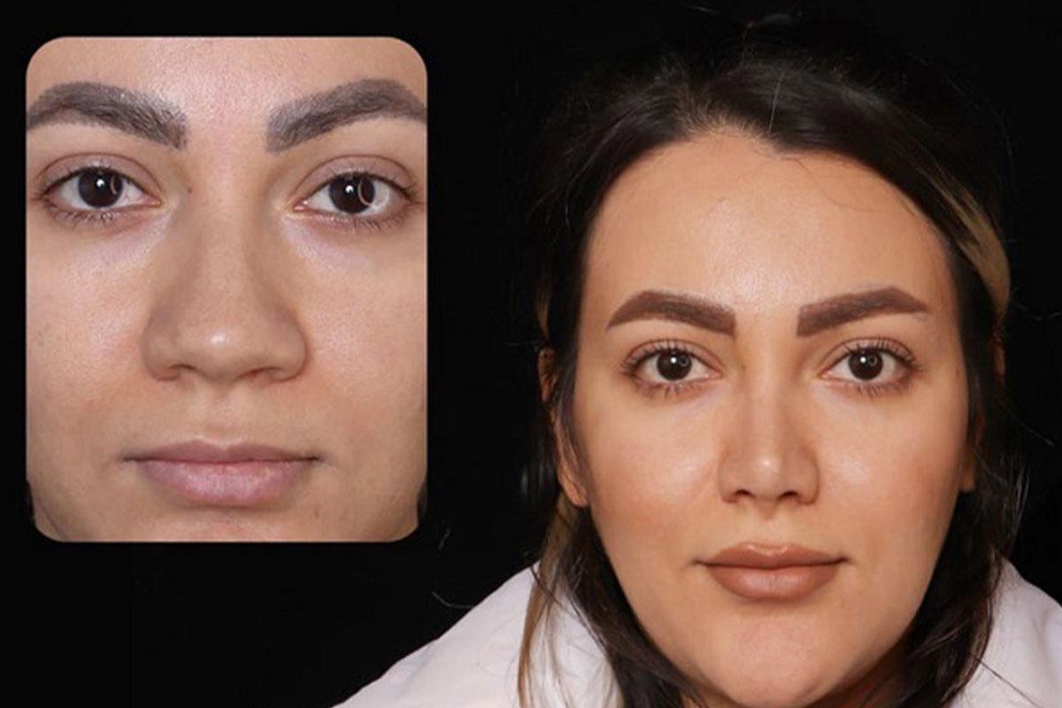 از کجا بفهمیم بینی نیاز به عمل دارد؟