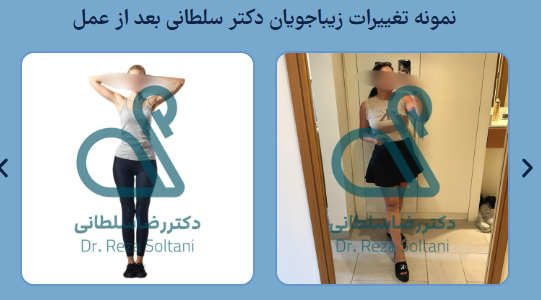 لیپوماتیک کل بدن همراه با لیفت پوست (تکنیک ترکیبی)